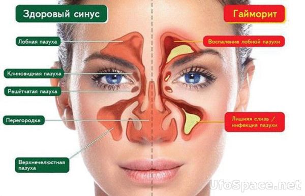 Пять природных средств для защиты от синусита